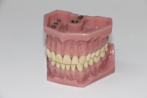 implant dentar